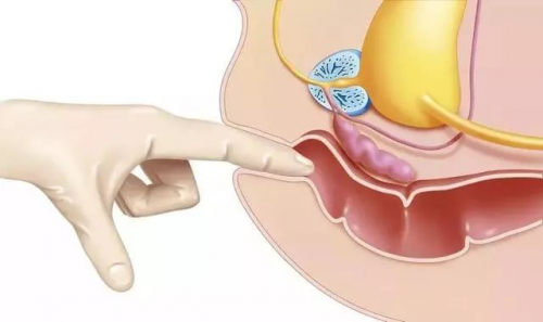 广州东大肛肠医院9博体育收费好不好_黑猫投诉提醒丨夏季肛肠疾病高发及早诊断是关键！(图3)